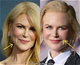 The Truth About Botox: Nicole Kidman's Experience